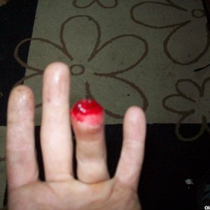 chain damaged bloody finger gokart injury